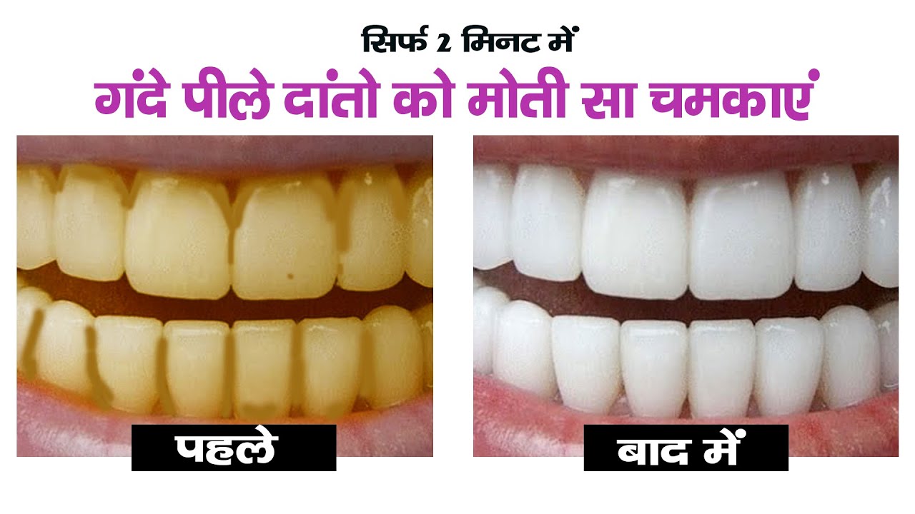 पीले दांतों को मोती जैसा सफेद बनाने के लिए अपनाएं ये रेमेडी